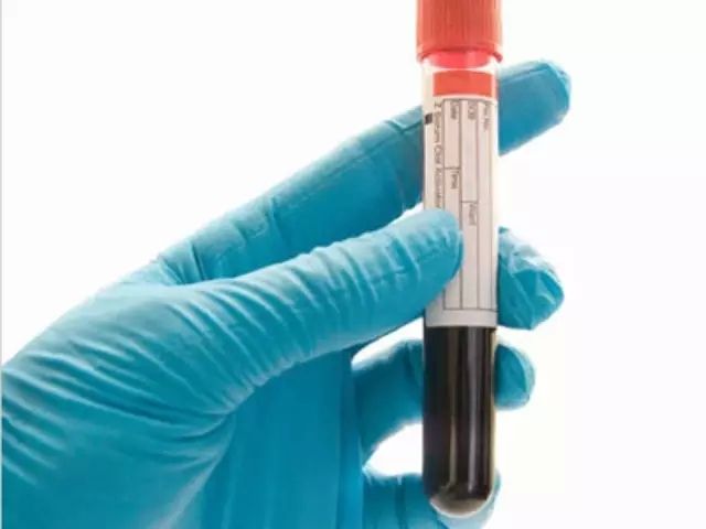 新的血液测试可以提前16年诊断类风湿性关节炎