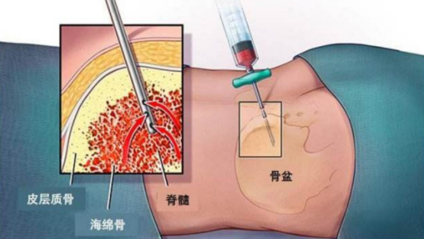 寡糖链可作为血液肿瘤诊断及预后的新型生物标志物