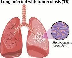 【推荐】早发现、早治疗！肺结核分子诊断技术研究进展解析